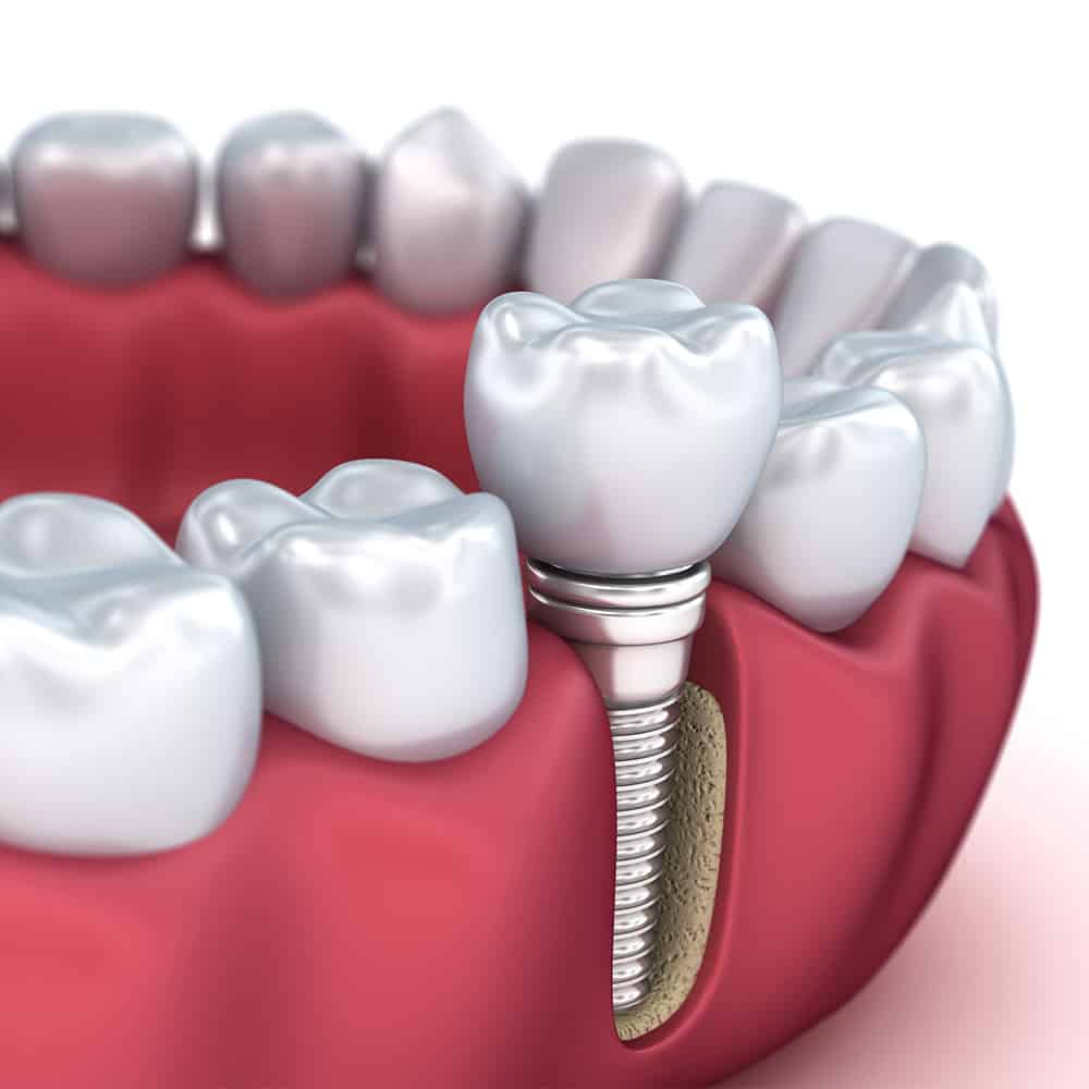 Fogászati implantáció, fogbeültetés