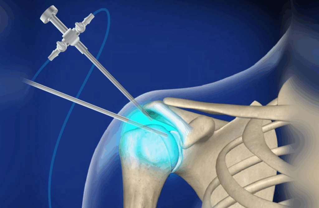 Vállortopedia, vállizületi kórkép